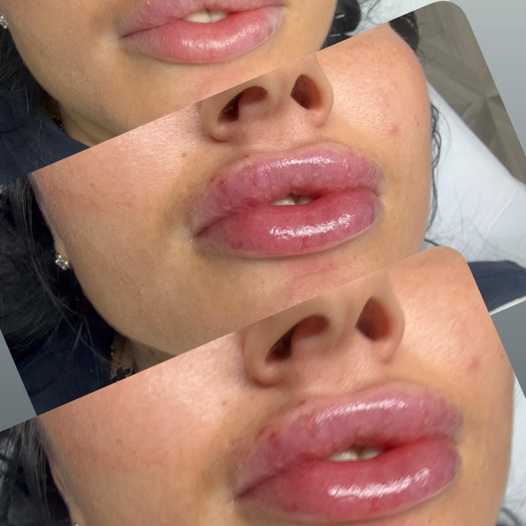 Mărire Buze Deva – rezultat procedură pentru volum și contur la Diva Beauty Forever